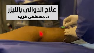 علاج الدوالي بدون جراحة في ٣٠ دقيقة بالليزر