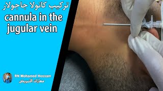 افضل طريقه لتعلم تركيب الكانولا الجاجولار بتفصيل _ Installing a cannula in the jugular vein