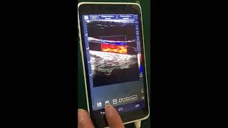 C-Scan is a handheld, pocket-sized ultrasound tool that provides real-time grayscale