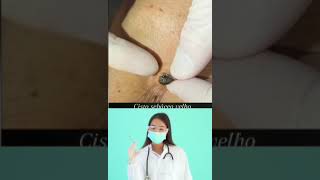 Dr.Nattacha, blackheads removal, extraction.