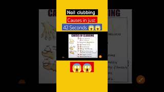 Nail clubbing causes Mnemonic #shortsviralvideo #shorts #shortsfeed