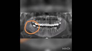 Wisdom tooth and alveolar nerve