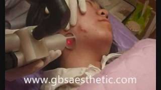 co2 fractional laser  skin resurfacing wrinkle removal and scar removal skin rejuvenation