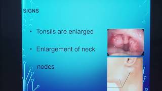 Chronic tonsillitis / To operate or not ?  / Tamil  / Patient teaching programme