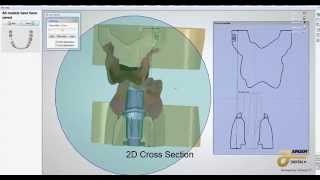 Digital Implant Abutment Design (Trios Color Scan) with Removable Model Dies