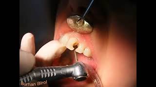 How Is Tooth Filling Made?