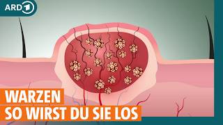 Warzen: So werden sie behandelt I ARD Gesund