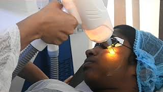 Laser Treatment For Pimple and Pigmentation