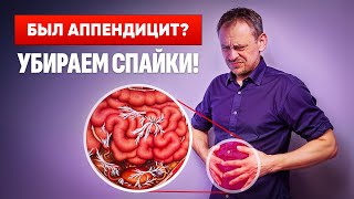 Удаление аппендицита - это почти всегда Спайки в животе! Самодиагностика и самомассаж последствий