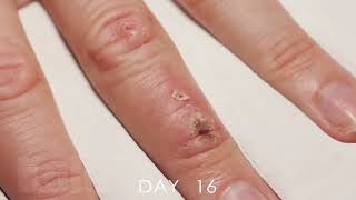 Timelapse Of A Wound Healing