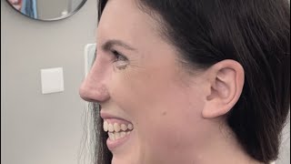 Recovery Day 10 After Closed Scarless Rhinoplasty | Dr. med. Simon Zimmermann