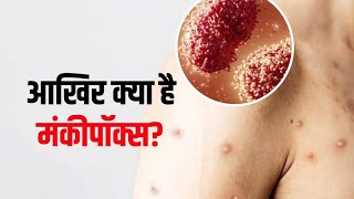 Monkey pox|sign and symptoms|prevention, treatment|monkey pox क्या हैं,कैसे होता हैं|पूरी जानकारी