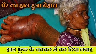 पैर का हाल हुआ बेहाल | झाड़ फूंक के चक्कर में कर दिया तबाह | snake bite | Bapi Da Snake Expert