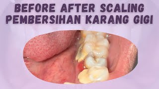 WDC_JANGAN BIARKAN GIGIMU PENUH DENGAN KARANG GIGI 🤢  | SCALING AFTER 24 Y.O | TARTAR REMOVING