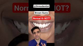 WAIT? BROWN GUMS A DISEASE? #gumhealth #gumrecession #gumdisease #dentalcaretips #periodontics