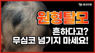 원형탈모?👨‍🦲 방치하다가 돌이킬 수 없습니다ㅣ흔한 탈모라고 생각하지 마세요!