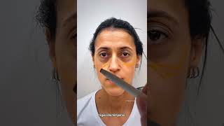 Caso transformador de harmonização facial pelo Dr Murilo Cecilio