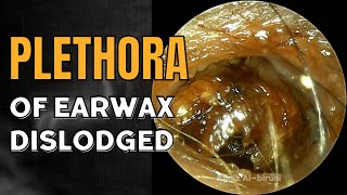 Plethora of Earwax Dislodged