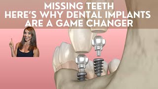 Missing Teeth - Here’s Why Dental Implants Are a Game Changer.