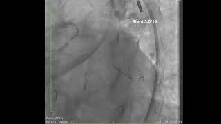 One of My Complicated PCI : Left Main PCI with IABP support.