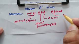 Mnemonic for absent A wave on JVP in less than half minute