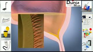 Resdung | Sinusitis