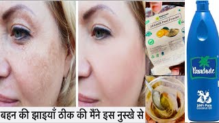 नारियल तेल में बस 1 चीज मिलने से झाइयों को जड़ से ख़त्म करें Pigmentation Removal