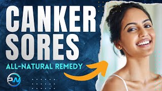 Canker Sores On Tongue: Remedy & Treatment To Get Rid Of Mouth Ulcer Symptoms