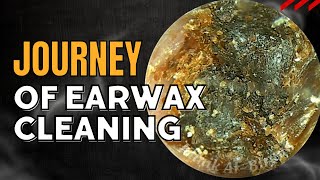 JOURNEY Of Earwax Cleaning