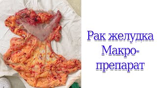 Рак желудка  Макропрепарат #ракжелудка #гистология #анатомия