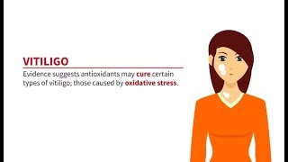 Antioxidants to Help Vitiligo