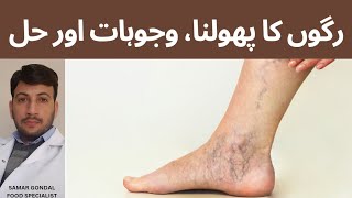 Vericose veins or spider veins treatment | Excercises to cure vericose veins or spider veins.