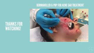 Acne Scar Treatment.Dermaroller + PRP.Brunilda Bardhi PhD Dermatologist