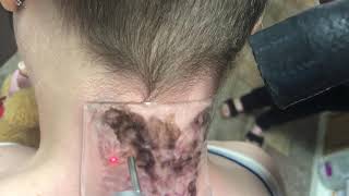 Laser tattoo removal on neck tattoo using PFD Describe patch