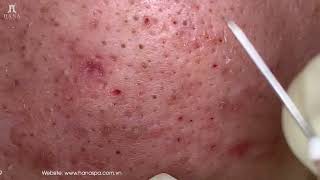 Big Cystic Acne Blackheads Extraction Blackheads & Milia, Whiteheads Removal Pimple Popping