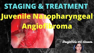 162.Juvenile Nasopharyngeal Angiofibroma Part 5 #Staging and Treatment #jna