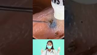 Dr.Nattacha, blackheads, extraction, surprise.