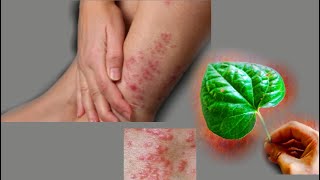 EMERGENCY, just apply this leaf on the skin and the scabies will disappear immediately  10 times