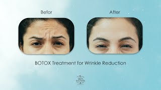 BOTOX Treatment for Wrinkle Reduction