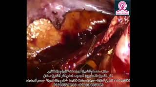 Laparoscopic hysterectomy / endometrial carcinoma