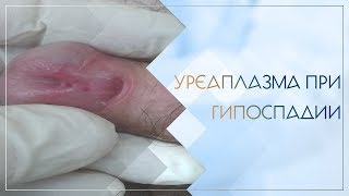 Уреаплазма при гипоспадии. Клинический случай №10