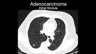 Recurrent Adenocarcinoma