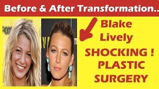 Blake Lively Plastic Surgery Before and After Full  HD