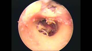 Temporal bone dissection endoscopic two handed part-1 (unedited)-dr.shreekantha acharya