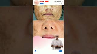 وصفة للتخلص من البقع الداكنة الدكتور عماد ميزاب Docteur Imad Mizab #short #shortvideo #shortsvideo