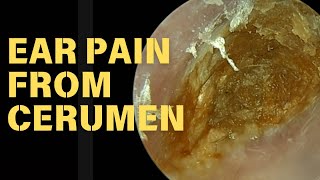 CATASTROPHIC Ear Pain From Impacted Cerumen