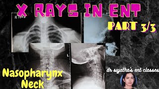 103.X ray classes for ENT undergraduates Part 3/3  #xrayclasses #clinicalexamination