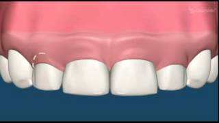 Dr.. Ross, Periodontist in Miami, FL Shares Periodontal Plastic Surgery (Crown Lengthening) Video