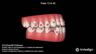 Invisalign laterale