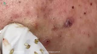 Big Cystic Acne Blackheads Extraction Blackheads & Milia, Whiteheads Removal Pimple Popping